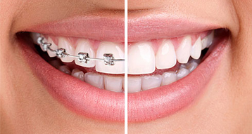 Apparecchi ortodontici trasparenti/ metallici